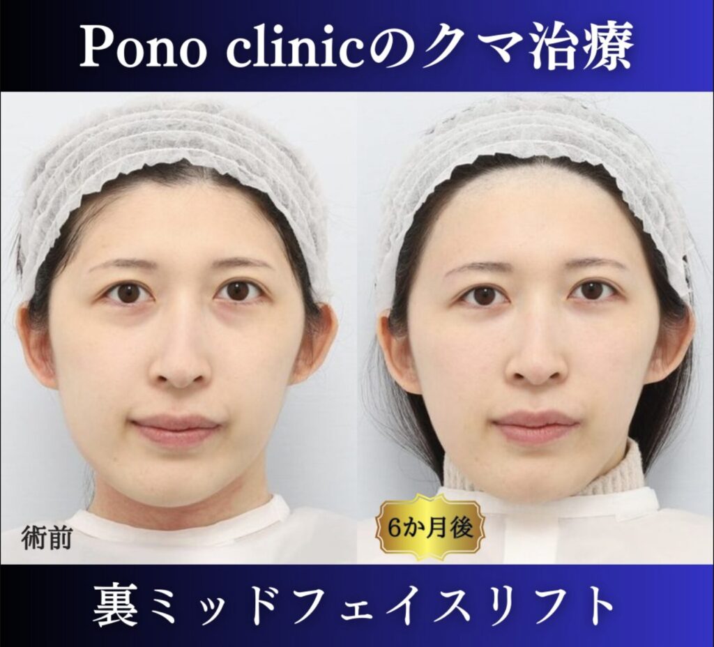 クマ取り東京、裏ハムラ、ミッドフェイスリフトの症例、半年後正面