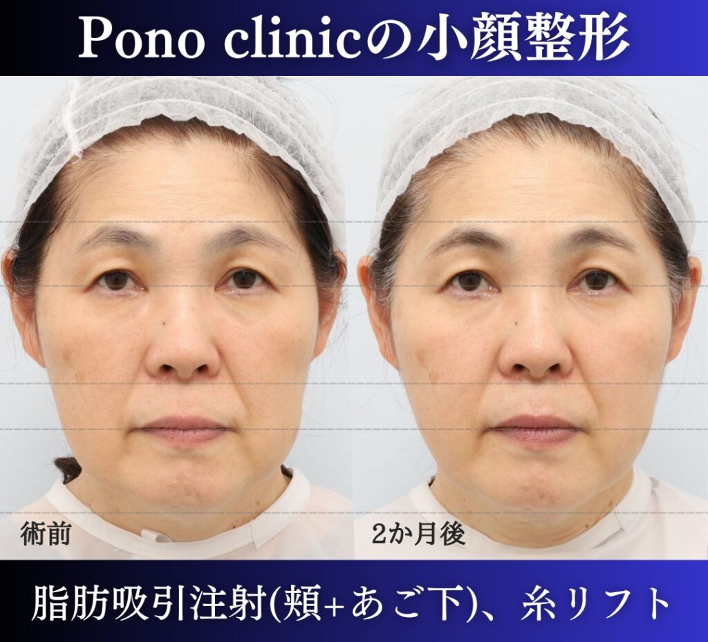 脂肪吸引、糸リフトの症例2か月後