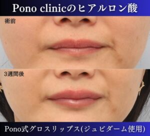 唇ヒアルロン酸注入の3週間後の症例