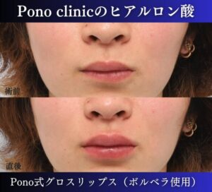 唇ヒアルロン酸注入の症例、直後 (11)
