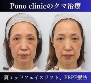 クマ取り東京、裏ハムラ・ミッドフェイスリフト、PRPF療法目の上の症例、前