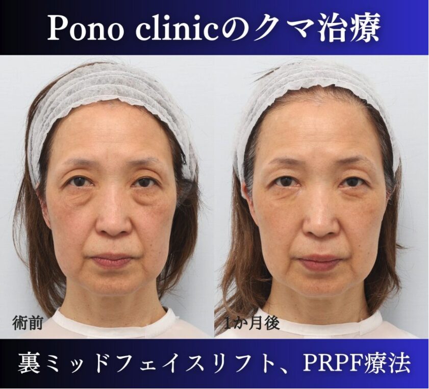 クマ取り東京、裏ハムラ・ミッドフェイスリフト、PRPF療法目の上の症例、前