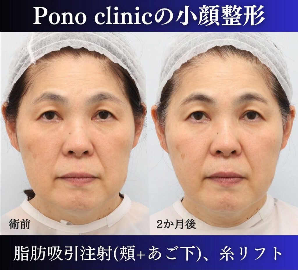 脂肪吸引、糸リフトの症例2か月後、線なし