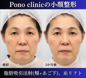 脂肪吸引、糸リフトの症例2か月後、線なし