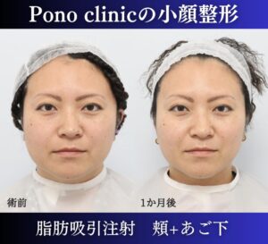 脂肪吸引注射頬+あご下の症例、1か月後正面