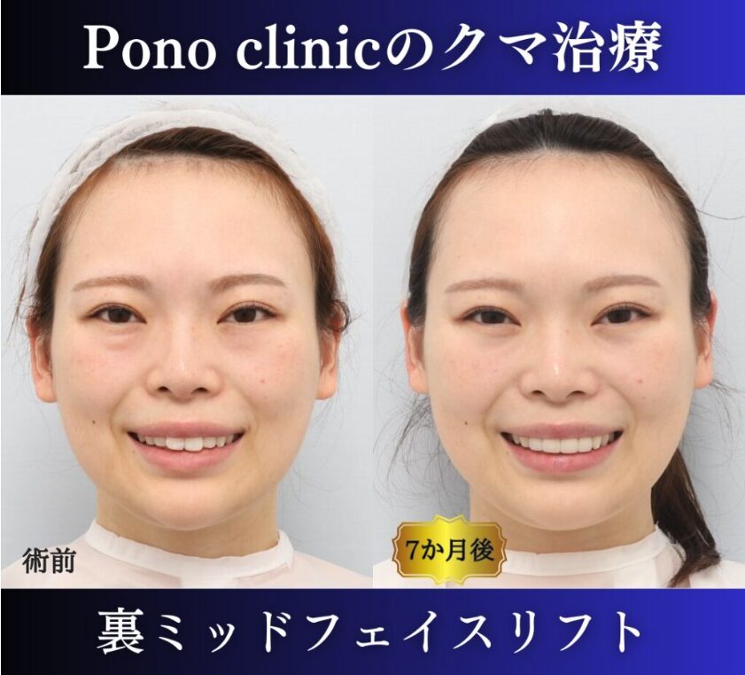 クマ取り東京、裏ミッドフェイスリフト20代の症例、7か月後笑顔