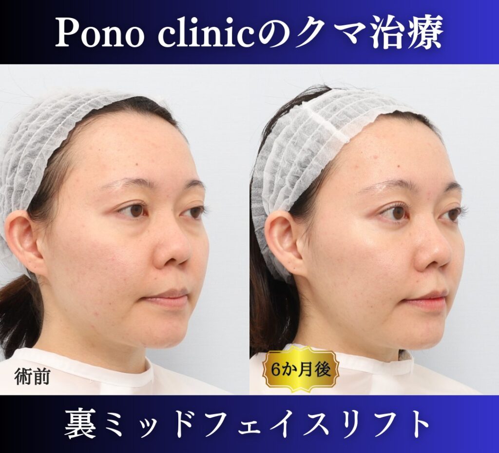 20代女性の裏ミッドフェイスリフト術前・術後を右斜位から比較した症例写真