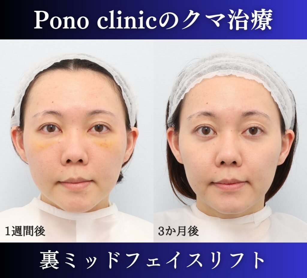 20代女性の裏ミッドフェイスリフト術前、1週間後、3か月後の経過を比較した症例写真