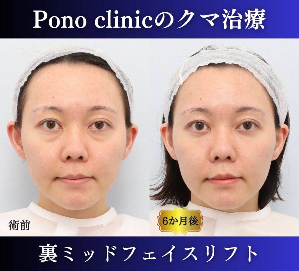 20代女性の裏ミッドフェイスリフト術前・術後を正面から比較した症例写真