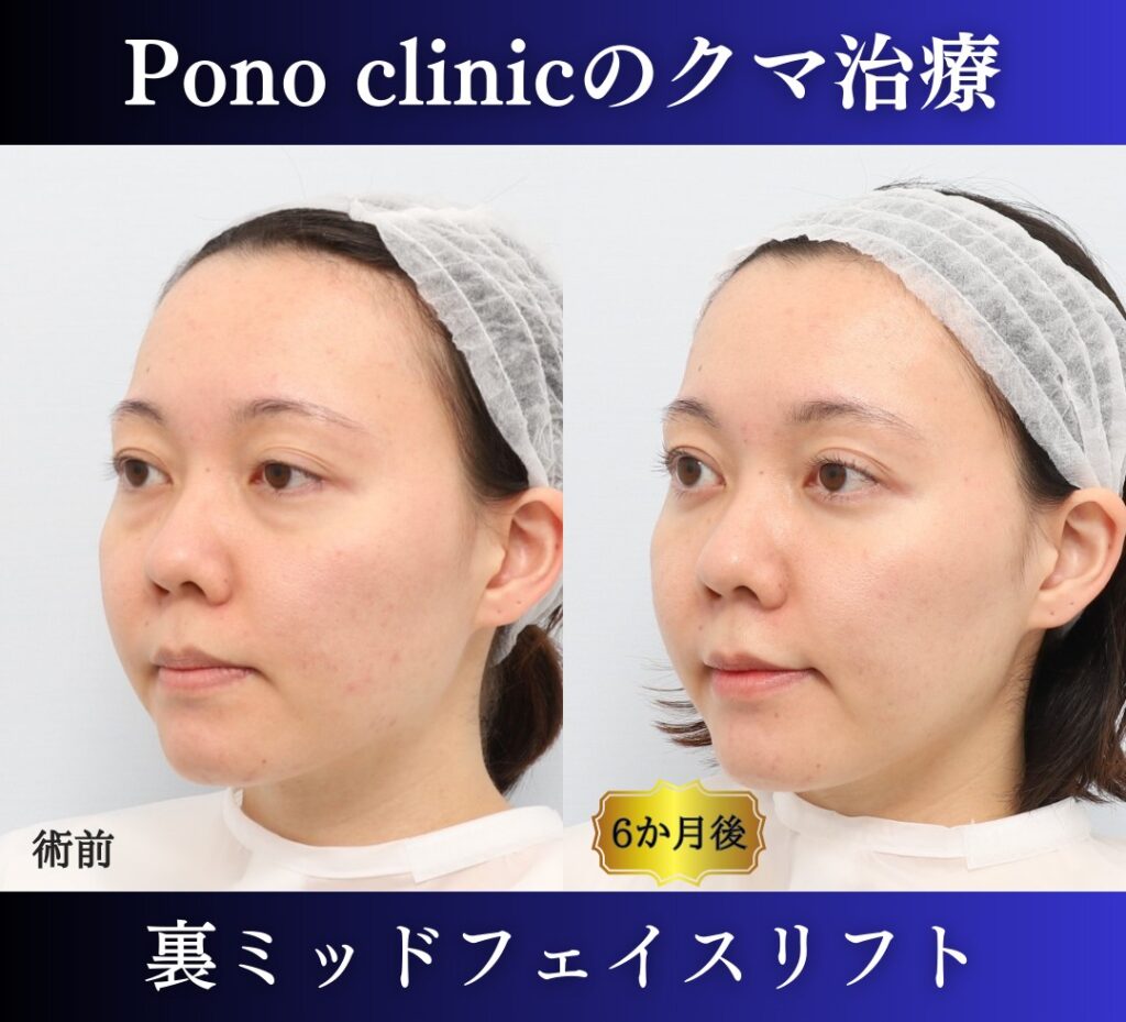 20代女性の裏ミッドフェイスリフト術前・術後を左斜位から比較した症例写真