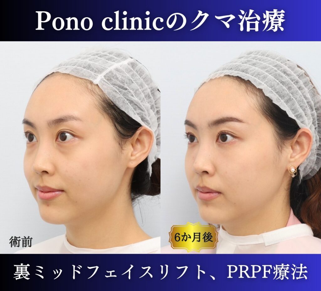 裏ハムラ、ミッドフェイスリフト、PRPF療法目の下の症例、9か月後 斜め