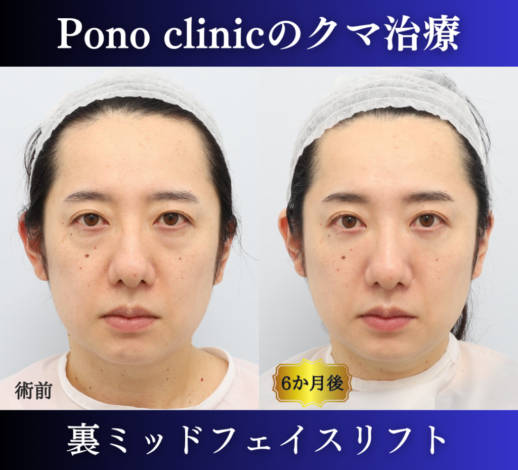 裏ハムラ、ミッドフェイスリフトの症例、40代 (5)
