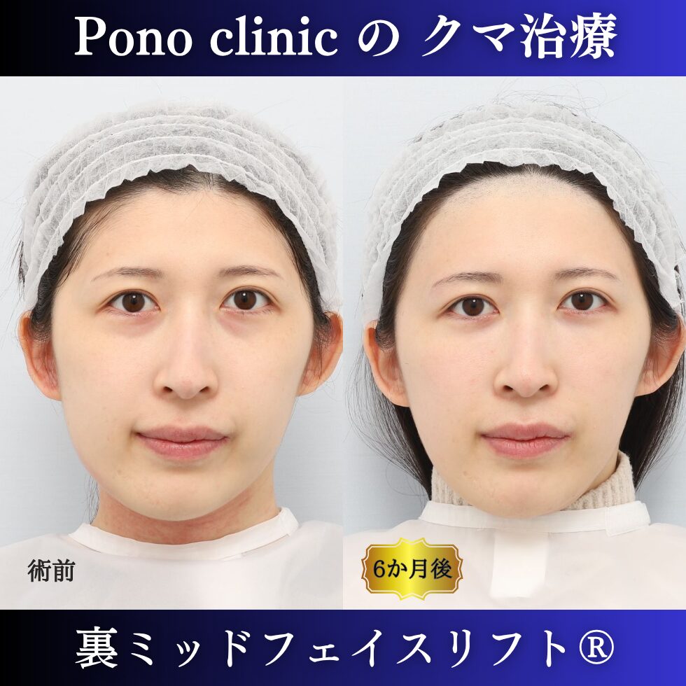 目の下のクマ、青クマ、裏ミッドフェイスリフト®、20代の症例