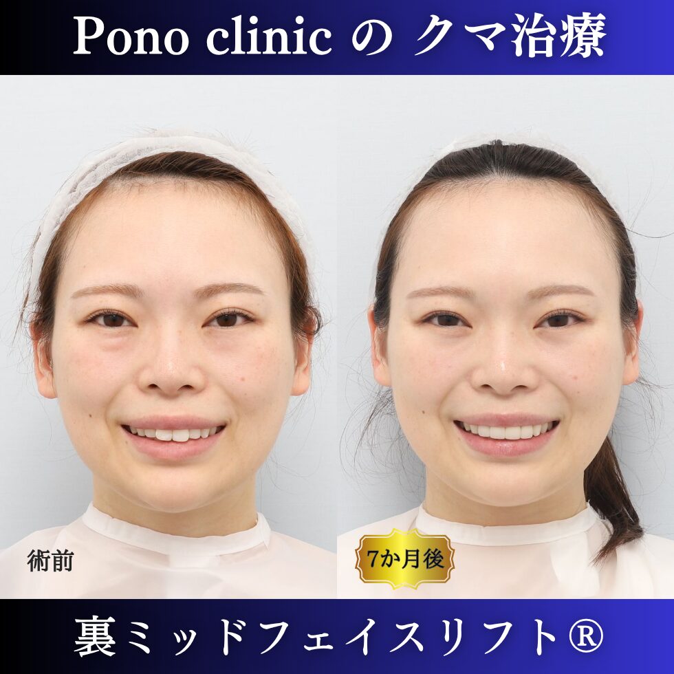 目の下のクマ、裏ミッドフェイスリフト®、透けクマ、20代の症例