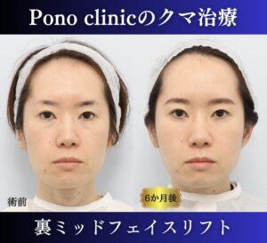 クマ取り東京、裏ハムラ+ミッドフェイスリフトの症例、30代 (1)