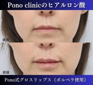 唇ヒアルロン酸注入、40代 (3)