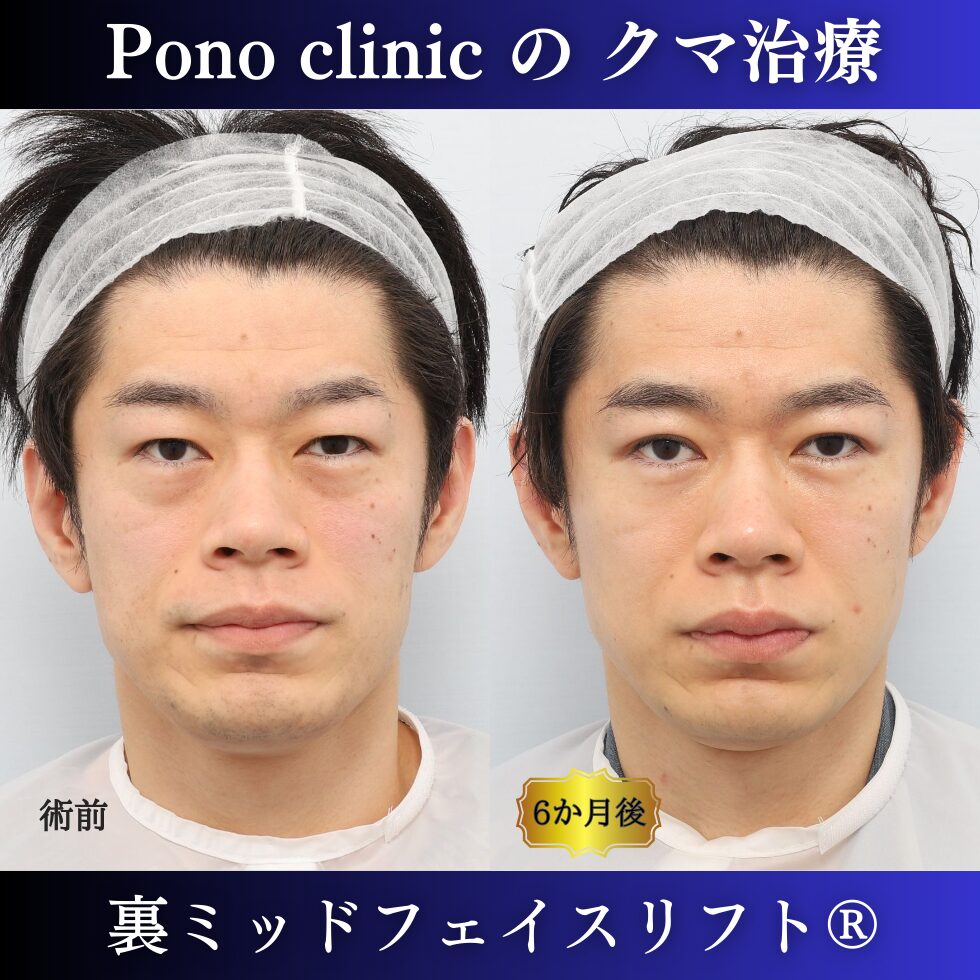 クマ取り東京、裏ハムラ、ミッドフェイスリフト、二重埋没法の症例30代男性