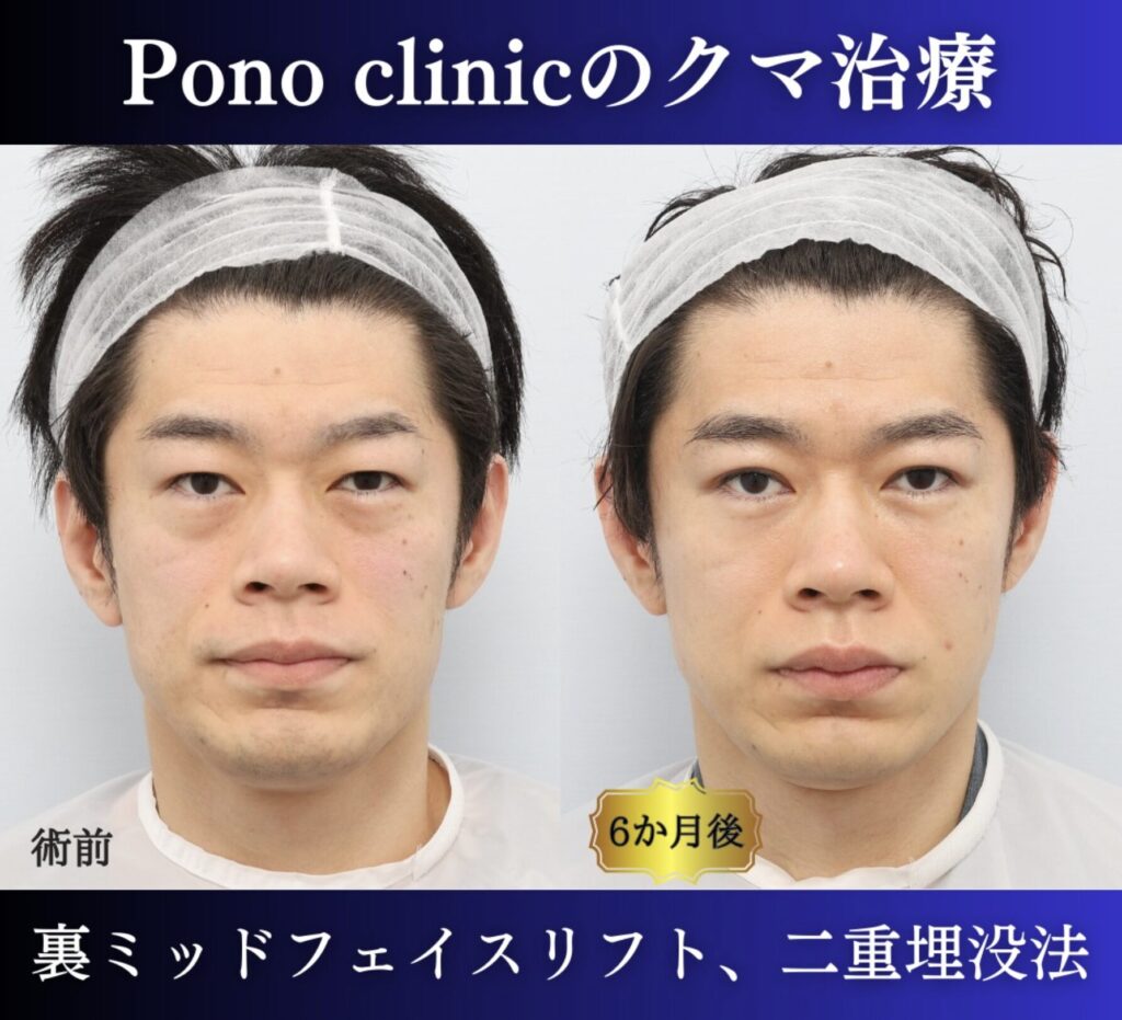 クマ取り東京、裏ハムラ、ミッドフェイスリフト、二重埋没法の症例30代男性 (1)