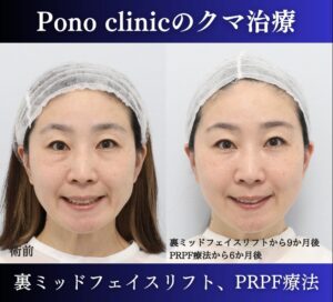 クマ取り東京、裏ハムラ、ミッドフェイスリフト+PRPF療法の症例 (3)