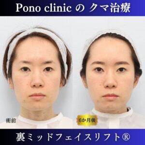 目の下のクマ治療、裏ミッドフェイスリフト、裏ハムラ法、骨膜下リフト、他院修正、30代の症例