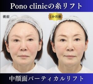 中顔面バーティカルリフトの症例、PCLLA6本使用 (1)