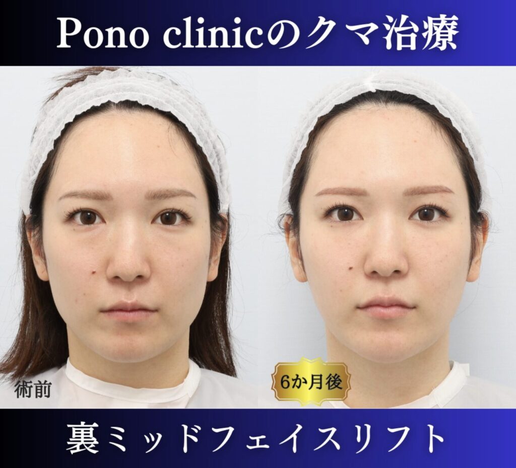 クマ取り東京、裏ハムラ法+ミッドフェイスリフトの症例、30代 (5)