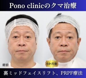 クマ取り東京、50代のクマ治療、 裏ハムラ+ミッドフェイスリフト、PRPF療法目の下 (1)