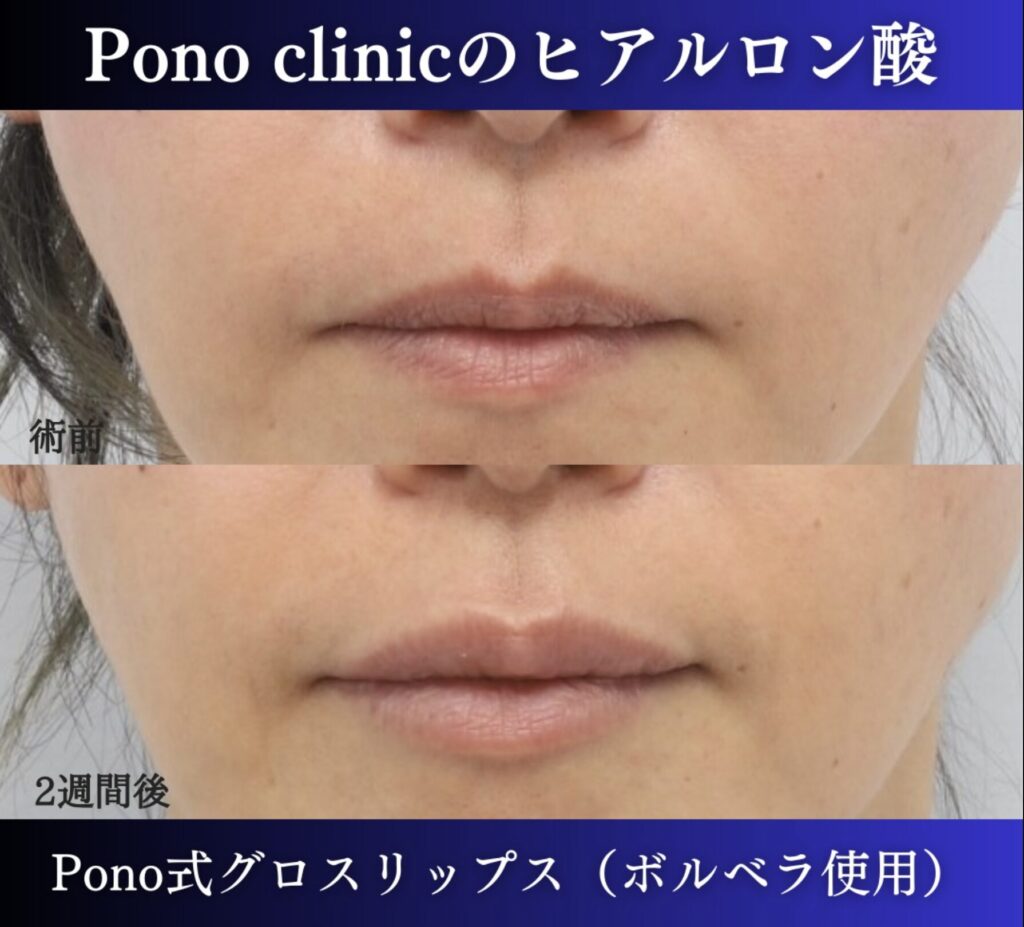 Pono式グロスリップスの症例 (1)