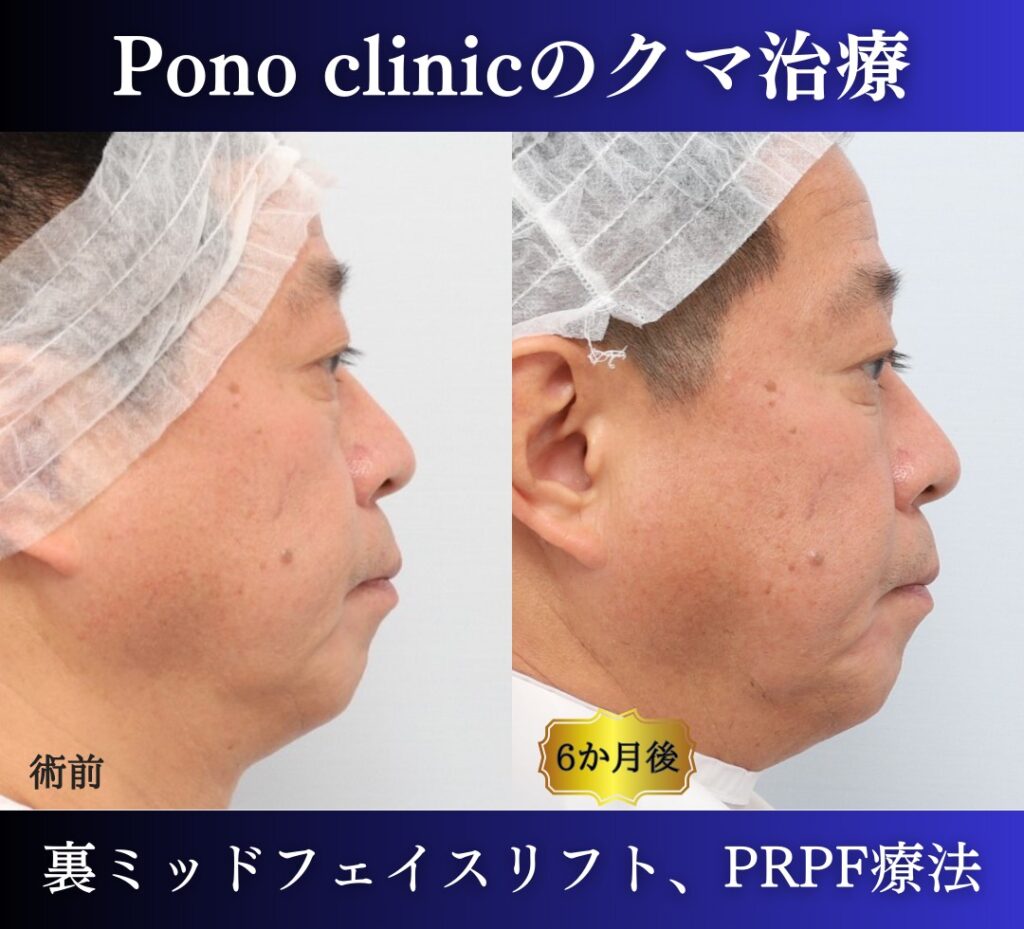 50代のクマ治療、 裏ハムラ+ミッドフェイスリフト、PRPF療法目の下 (3)