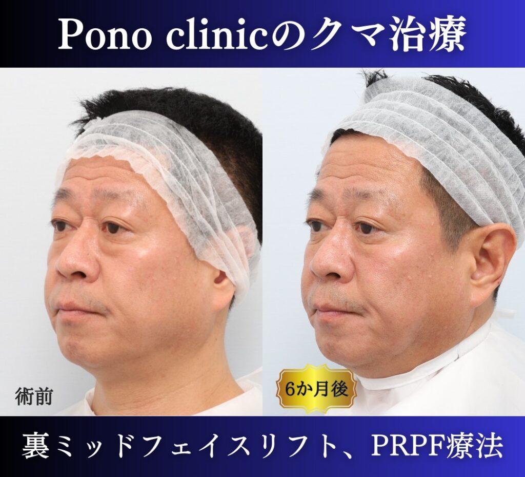 50代のクマ治療、 裏ハムラ+ミッドフェイスリフト、PRPF療法目の下 (5)