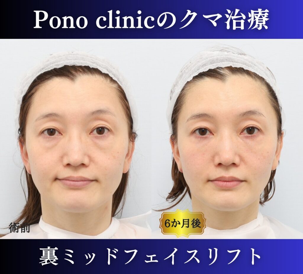 40代のクマ治療、裏ミッドフェイスリフトの症例 (1)