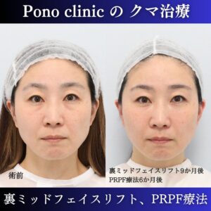 目の下のクマ治療、裏ミッドフェイスリフト、PRPF療法、40代の症例