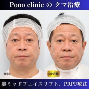 目の下のたるみ、目の下のクマ、裏ミッドフェイスリフト、裏ハムラ法、骨膜下リフト、50代男性の症例