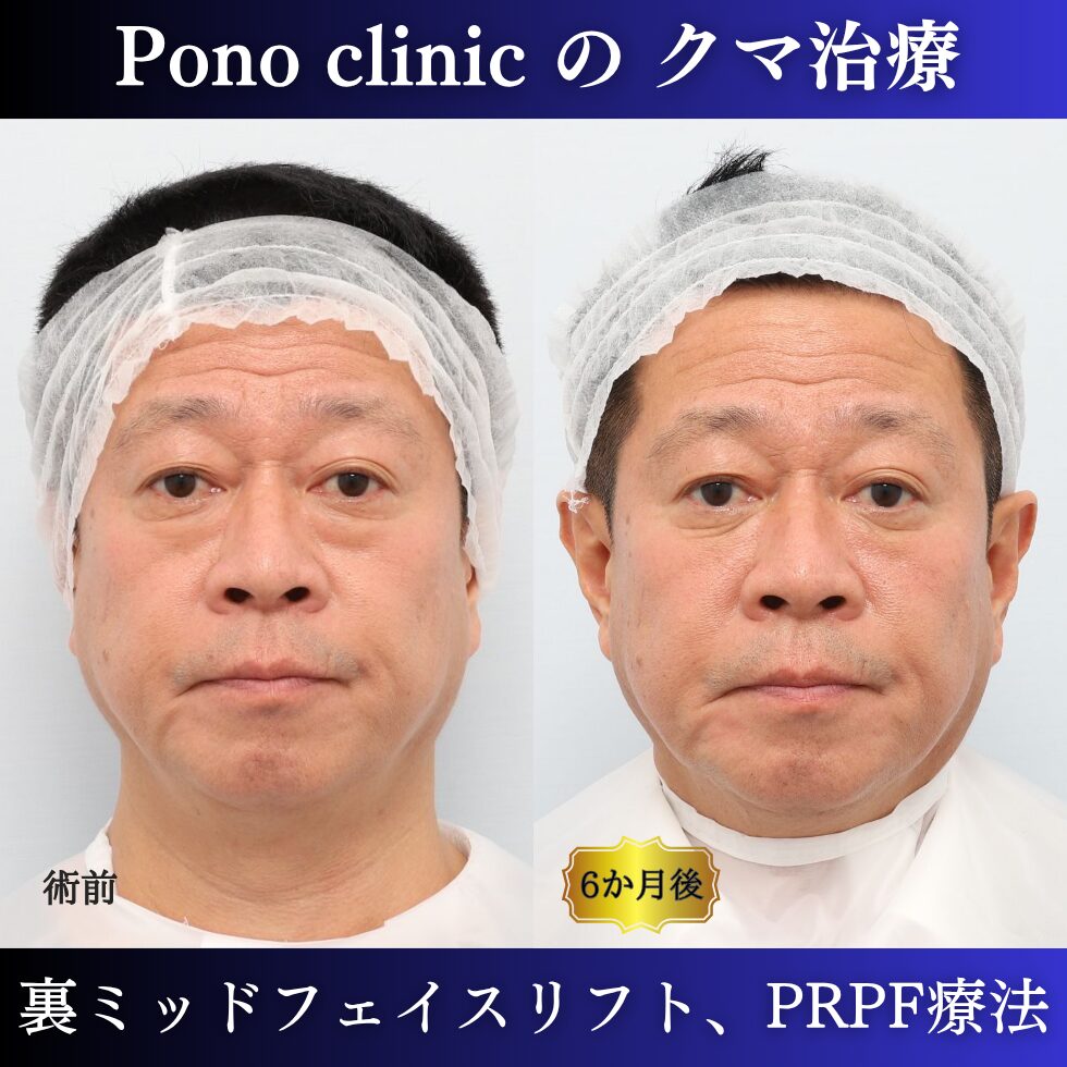 目の下のたるみ、目の下のクマ、裏ミッドフェイスリフト、裏ハムラ法、骨膜下リフト、50代男性の症例