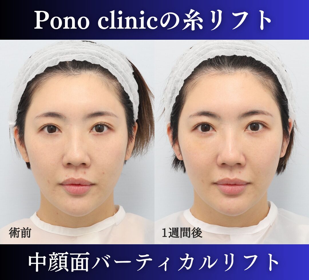 中顔面バーティカルリフトで頬の重心を整えた30代の症例