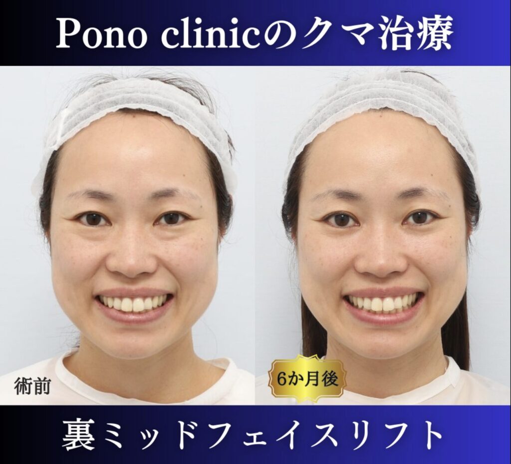 クマ取り東京、30代女性、裏ミッドフェイスリフト