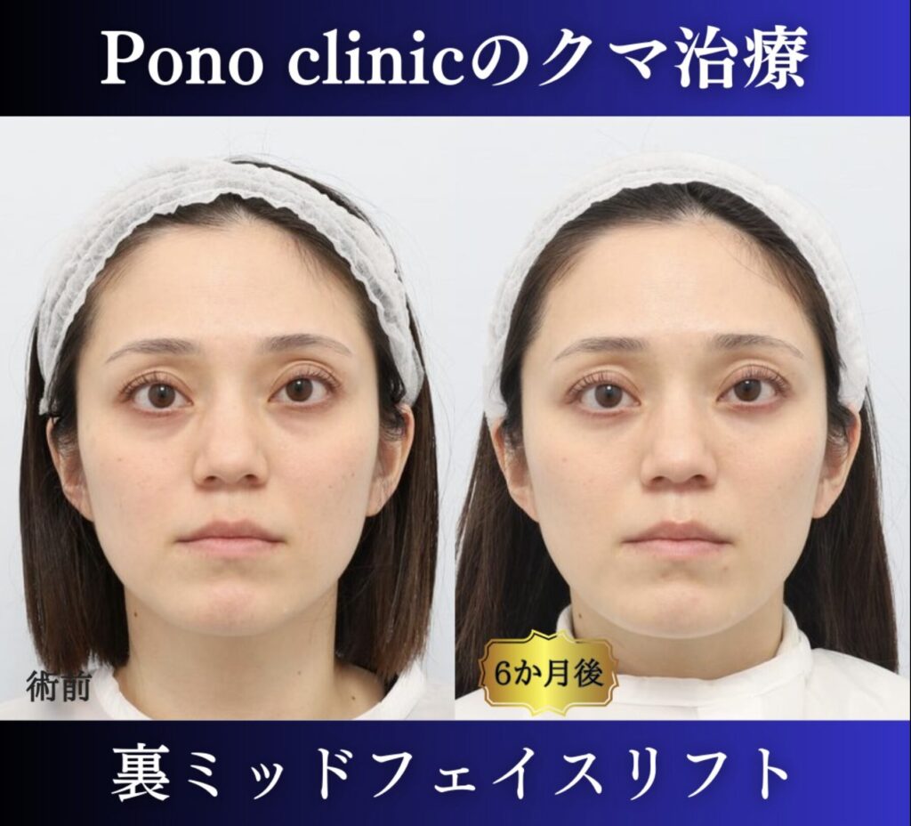 クマ取り東京、、裏ハムラ+ミッドフェイスリフトの症例 (4)