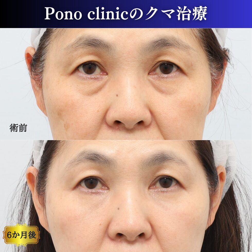 50代、クマ治療、裏ハムラ+ミッドフェイスリフト