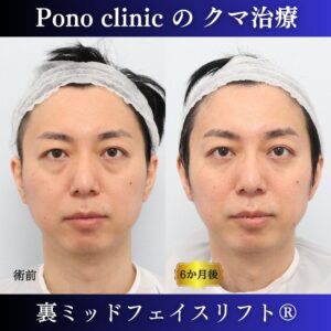 クマ取り東京、裏ミッドフェイスリフト、40代男性