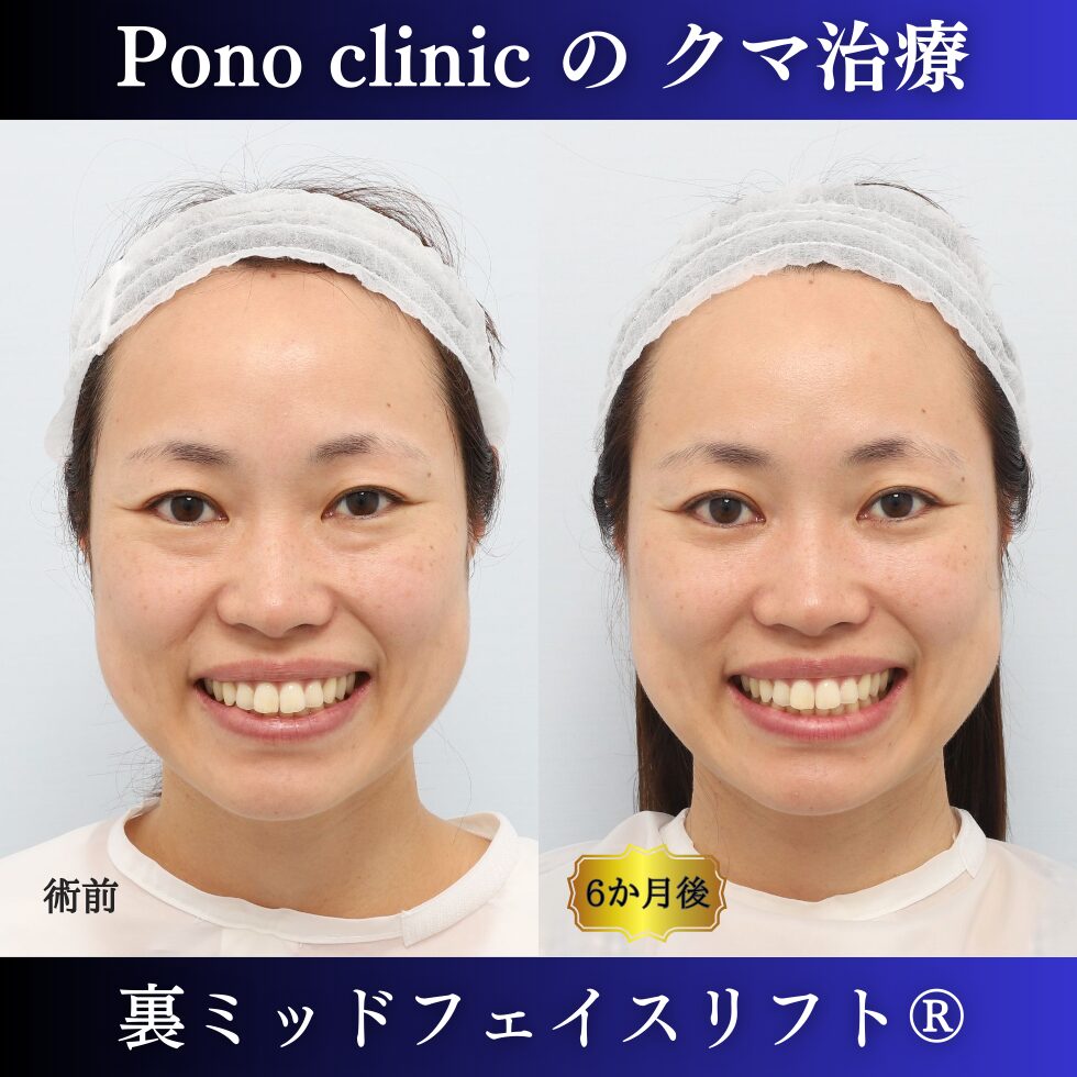 クマ取り東京、30代女性、裏ミッドフェイスリフト