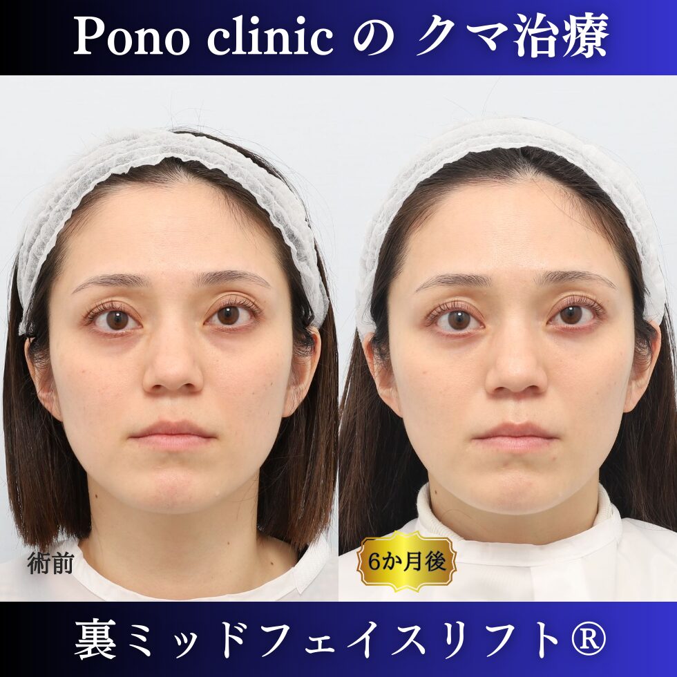 クマ取り東京、、裏ハムラ+ミッドフェイスリフトの症例