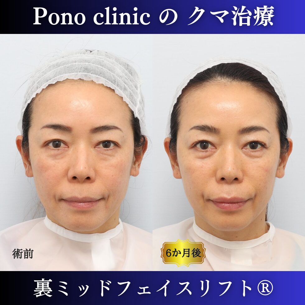 クマ取り東京、50代のクマ治療、裏ミッドフェイスリフト