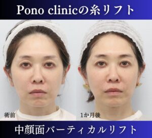 中顔面バーティカルリフト（糸リフト）、40代の症例 (2)