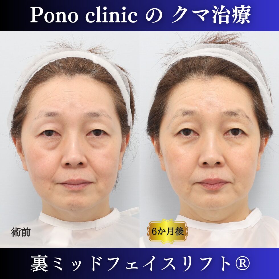 クマ取り東京、裏ミッドフェイスリフト、50代女性の症例