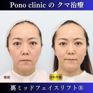 クマ取り東京、40代のクマ治療、裏ミッドフェイスリフト