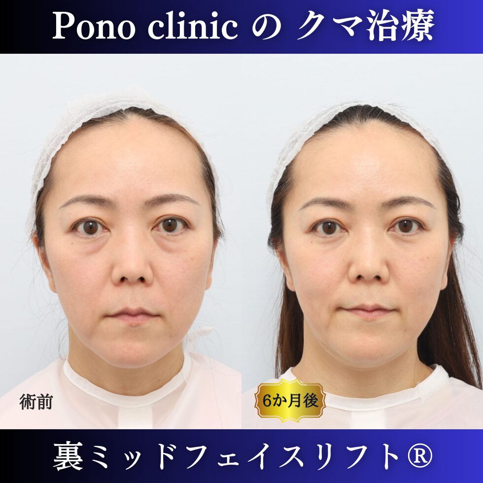 クマ取り東京、40代のクマ治療、裏ミッドフェイスリフト