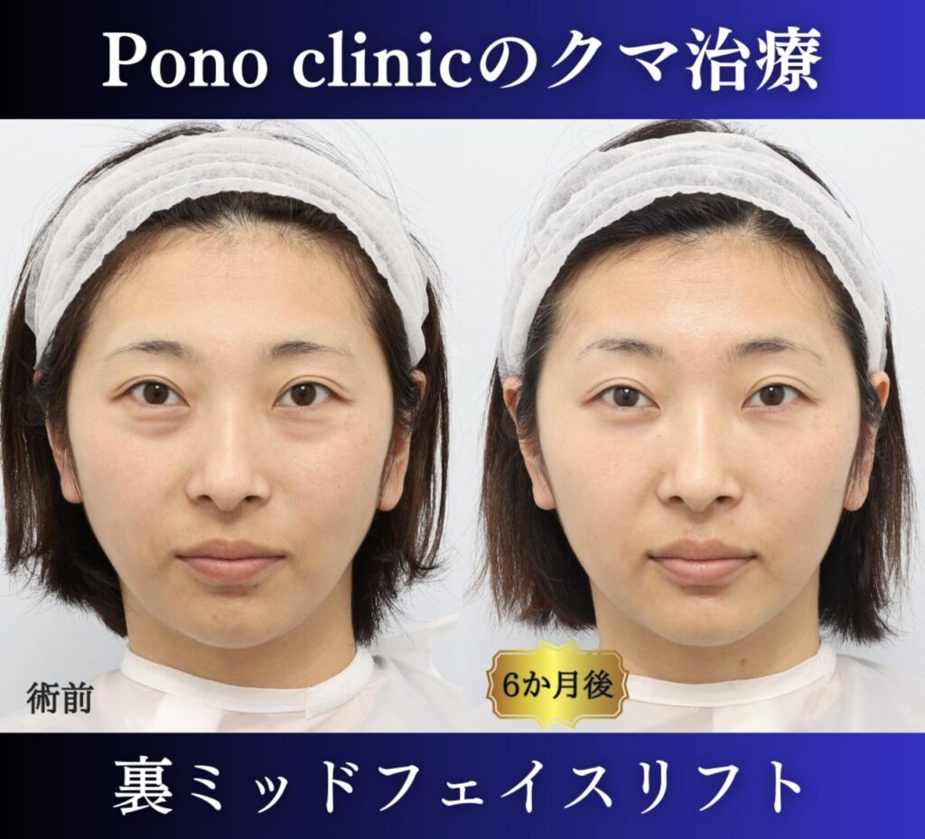 クマ取り東京、裏ミッドフェイスリフト、30代女性の症例 (1)