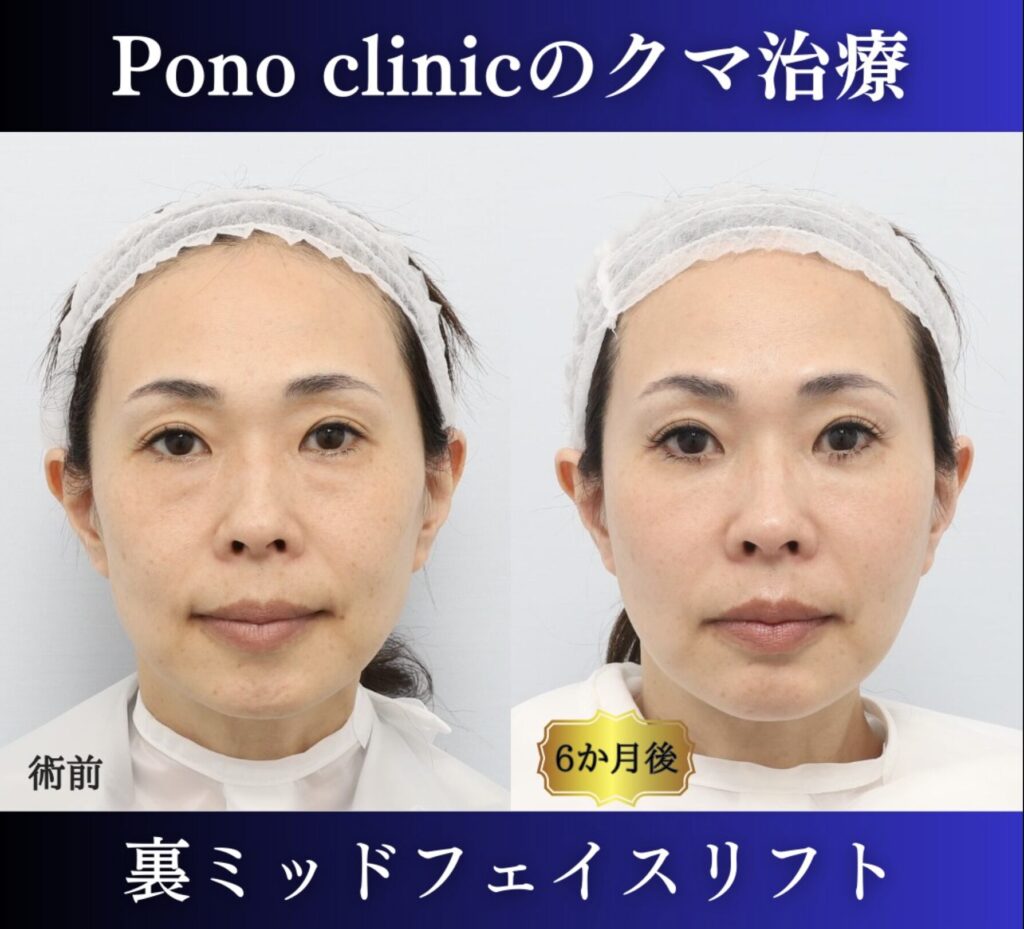 クマ取り東京、裏ミッドフェイスリフト、PRPF療法法令線、40代女性の症例 (1)