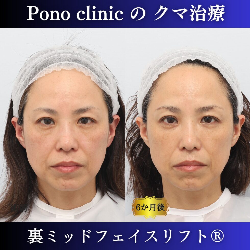 クマ取り東京、裏ミッドフェイスリフト、40代女性の症例