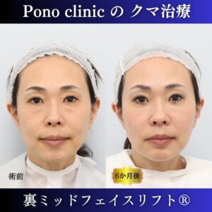 クマ取り東京、裏ミッドフェイスリフト、PRPF療法法令線、40代女性の症例
